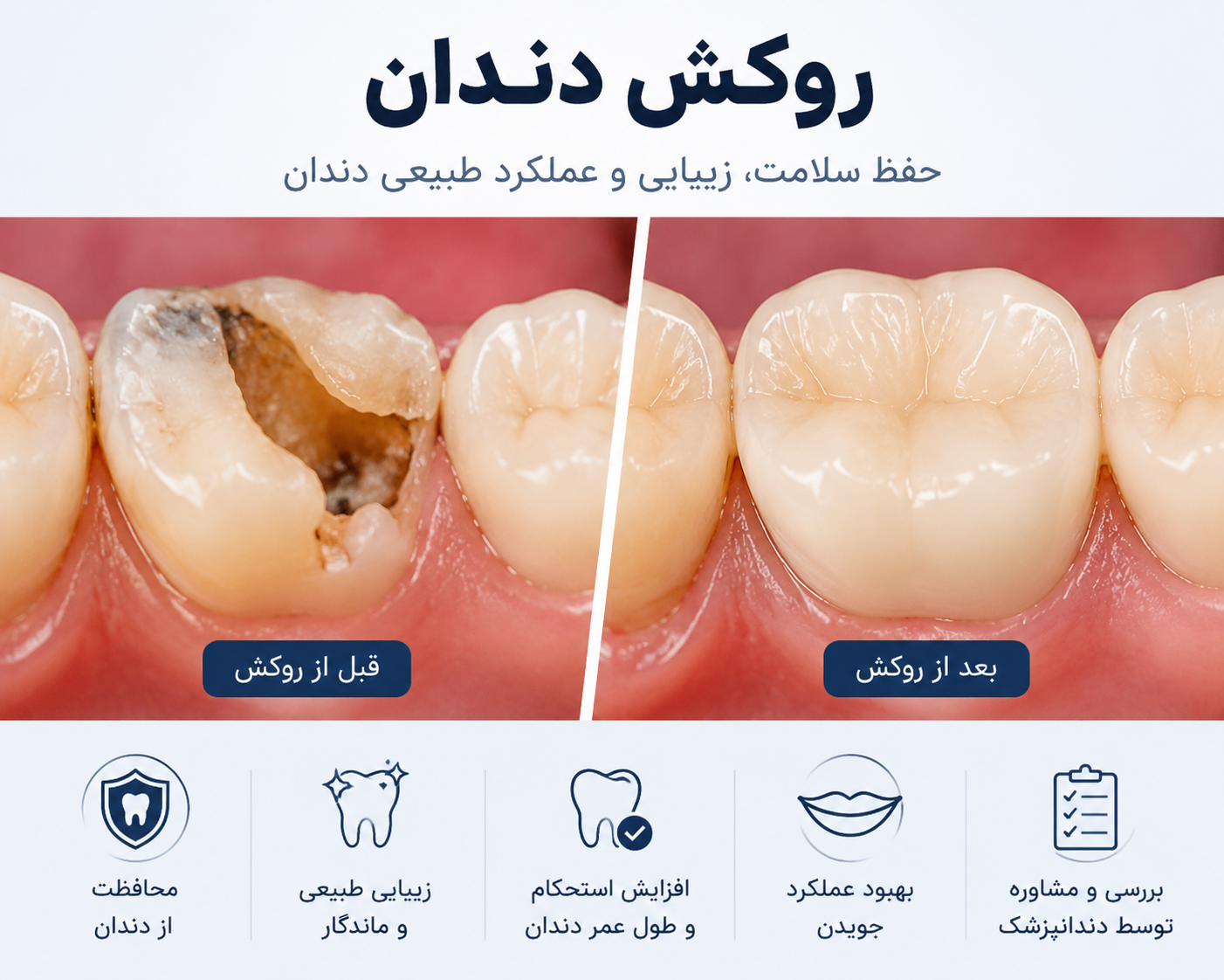 روکش دندان چیست؟ انواع روکش، مراحل انجام و مراقبت‌های بعد از آن